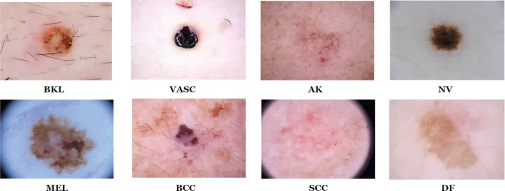 Figure 2 from “Leveraging DermoGrabcut Segmentation for Improved CNN-Based Skin Lesion Classification”